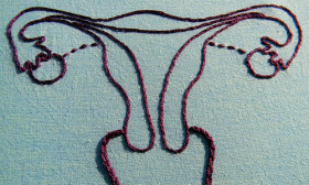 All You Wanted To Know About Ovarian Cysts