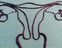 All You Wanted To Know About Ovarian Cysts