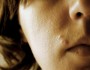 Top 6 Home Remedies For Zits
