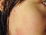 How To Get Rid Of Pimple Scars?
