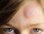 How to Treat Bruises The Right Way? 