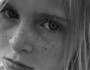 6 Easiest ways to Get Rid of Freckles