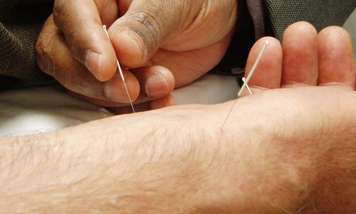 7 Benefits of Acupuncture