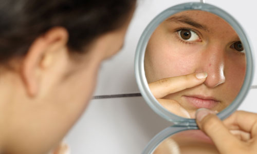 8 Home Remedies to Lighten Your Acne Scars