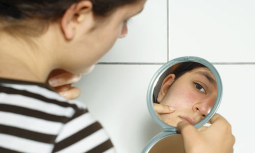 6 Ways to Get Rid of Acne Scars