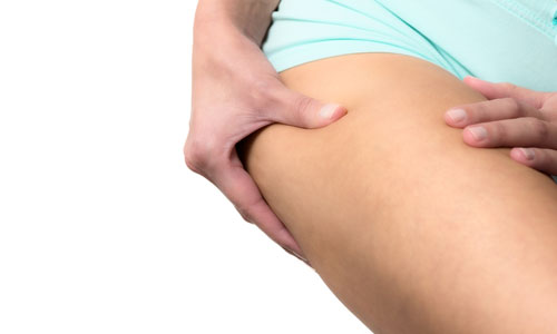Reasons Why Cellulite can not be Treated