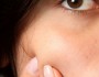 How To Remove Whiteheads?