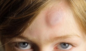 How to Treat Bruises The Right Way?