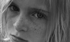 6 Easiest ways to Get Rid of Freckles